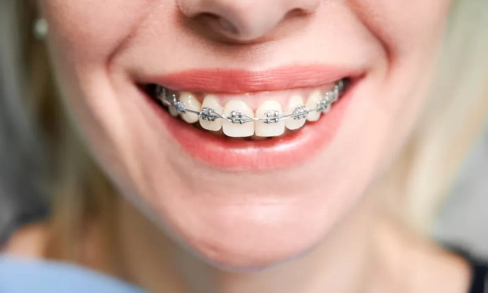 adio-aparat-dentar-fix