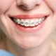 adio-aparat-dentar-fix
