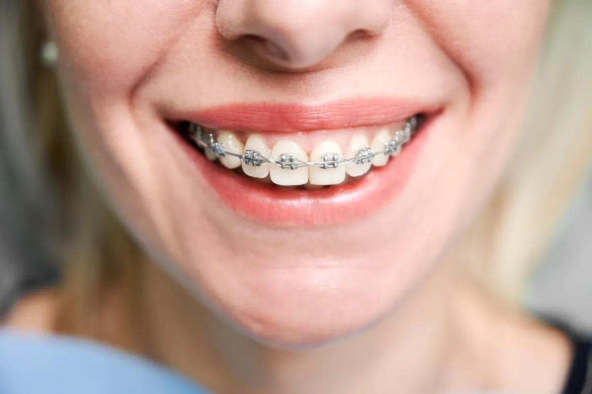 adio-aparat-dentar-fix